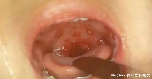 但是这次症状还好,嗓子虽然是疱疹,但是看着比上次少很多.