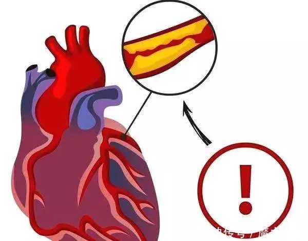 血脂高如何降低血脂